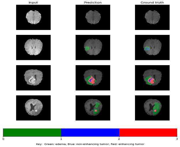 /img/about/braintumour